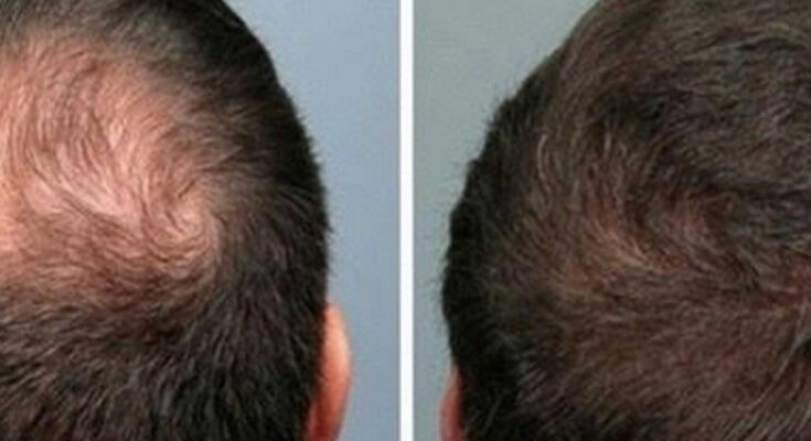 Hair Loss & Growth Treatment Market