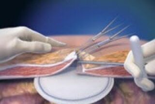 Hernia Repair Devices and Consumables Market