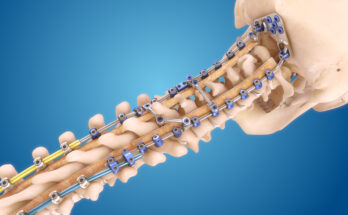 Spinal Implants and Devices Market