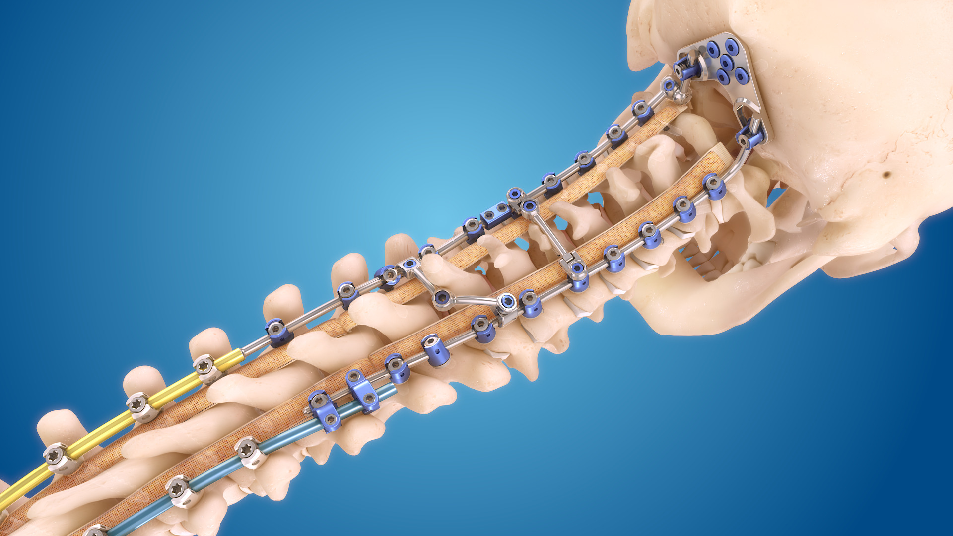 Spinal Implants and Devices Market