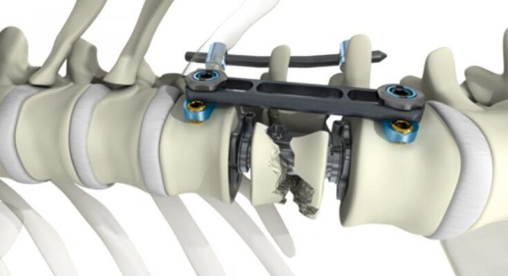 Spinal Thoracolumbar Implants Market