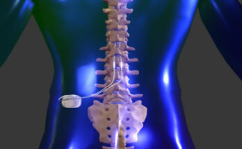 Implantable Spinal Cord Stimulation System Market