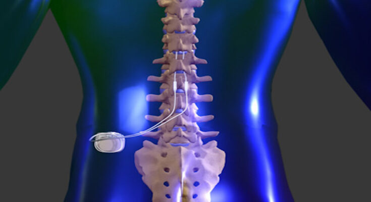Implantable Spinal Cord Stimulation System Market
