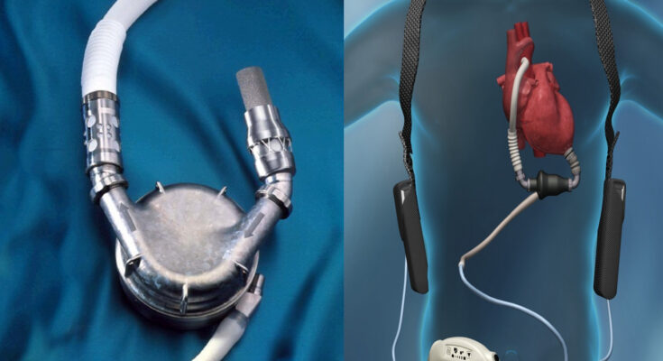 Single-ventricular Extracorporeal Life Support Devices Market