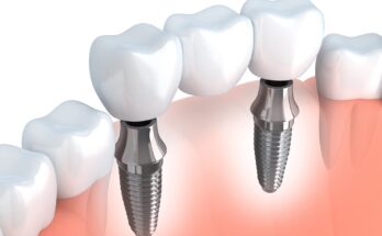 Dental Implant and Dental Prosthetic Market
