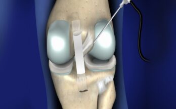 ACL and PCL Reconstruction Device Market