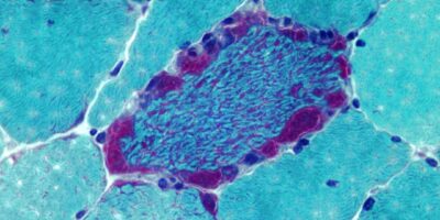 Mitochondrial Myopathy Diagnosis & Treatment Market