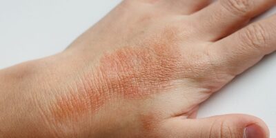 Allergic Contact Dermatitis (ACDS) Market