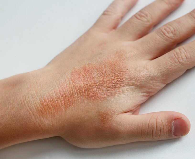 Allergic Contact Dermatitis (ACDS) Market