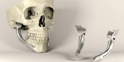 Custom 3D Printed Implants Market