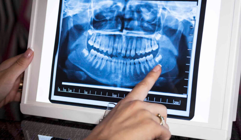 Extra Oral Dental X-Ray System Market