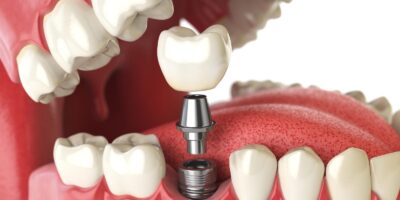 Dental Implants & Dental Prosthetics Market