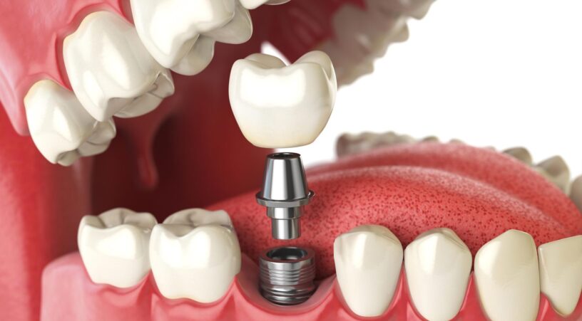 Dental Implants & Dental Prosthetics Market