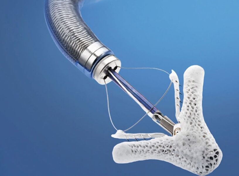 Anastomosis Assist Device Market