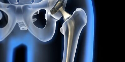 Arthroplasty Market