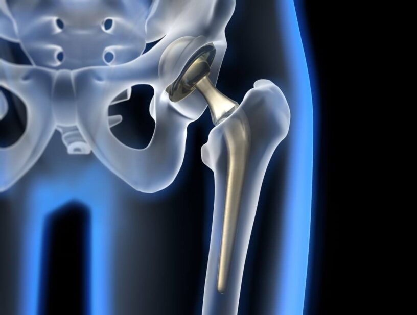 Arthroplasty Market