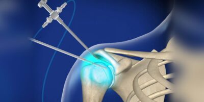 Arthroscopic Devices Market