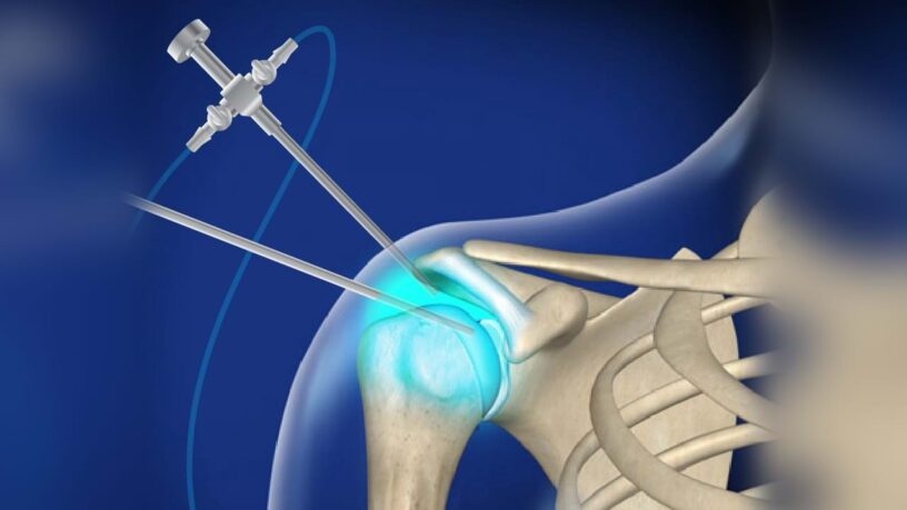 Arthroscopic Devices Market