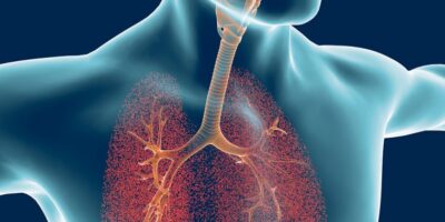 Bronchiectasis Treatment Market