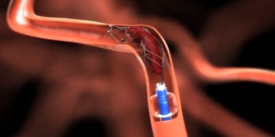 Cerebral Thrombectomy Systems Market