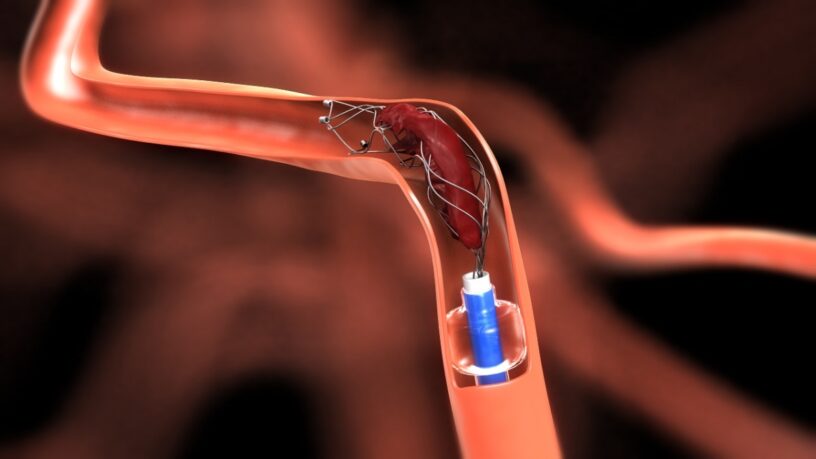 Cerebral Thrombectomy Systems Market