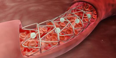 Cerebral Vascular Stents Market