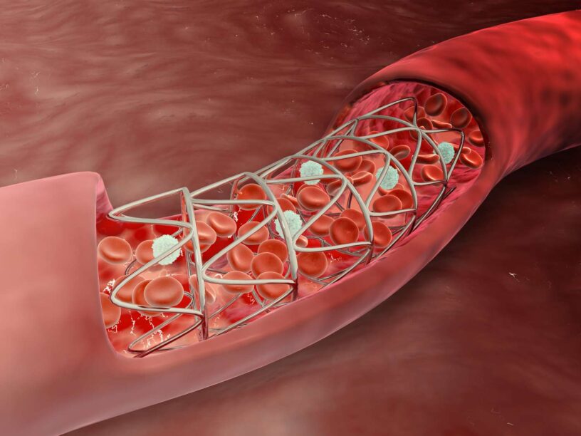 Cerebral Vascular Stents Market