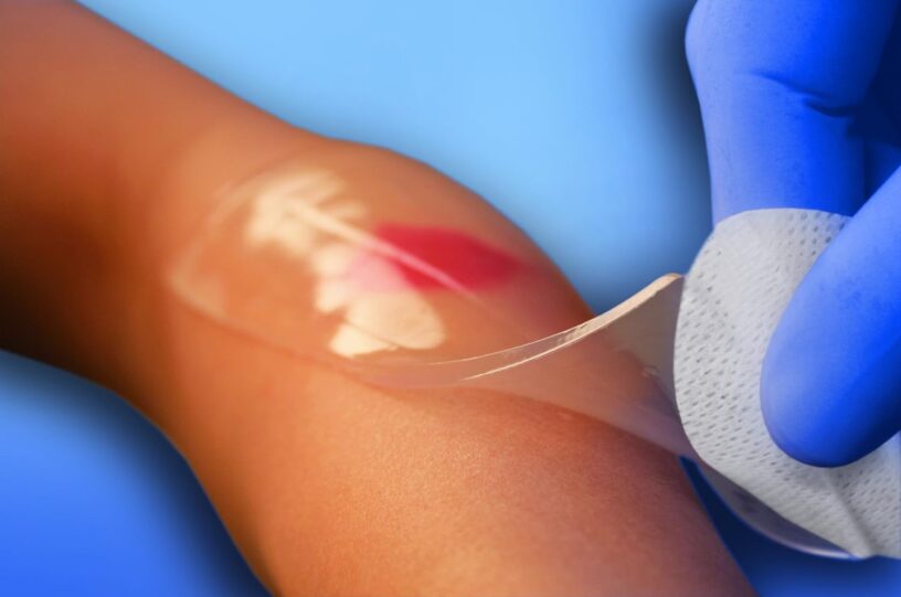 Moist Wound Dressings Market