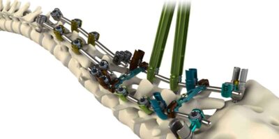 Thoracolumbar Spine Devices Market