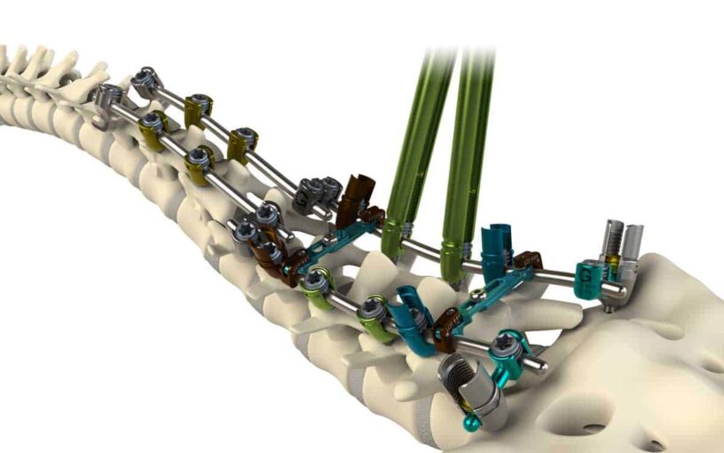 Thoracolumbar Spine Devices Market