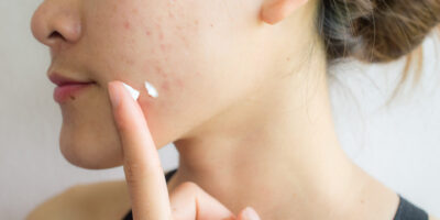 Acne Medication Market