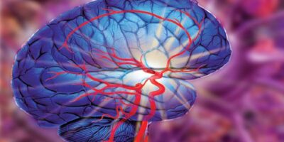 Acute Ischemic Stroke Diagnosis and Treatment Market