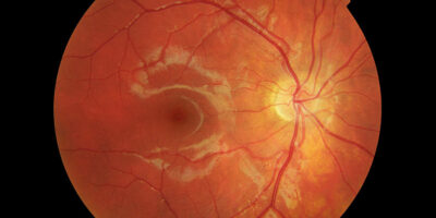 Age Related Macular Degeneration (AMD) Market