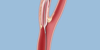 Carotid Artery Stents Market