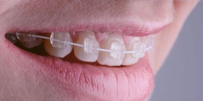 Ceramic Braces Market