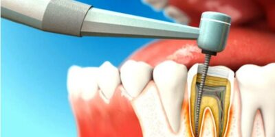 Dental Endodontics Market