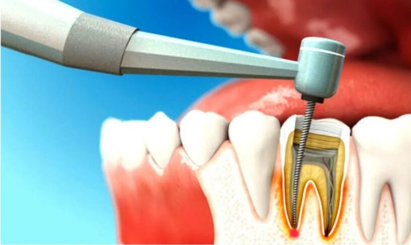 Dental Endodontics Market