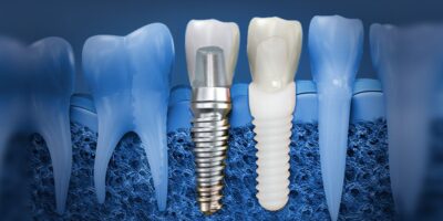 Dental Implant Surgery Tools Market