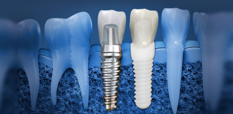 Dental Implant Surgery Tools Market