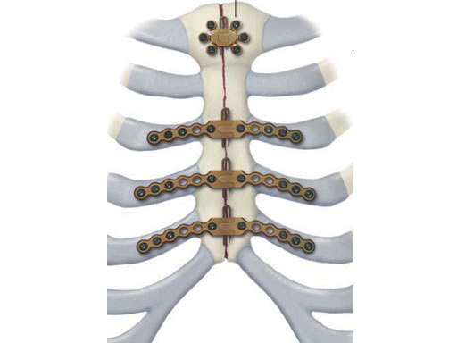 Sternal Closure Systems Market