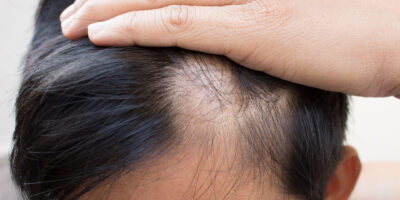 Alopecia (Hair Loss)Treatment Market