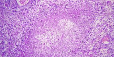 Anaplastic Oligoastrocytoma Market