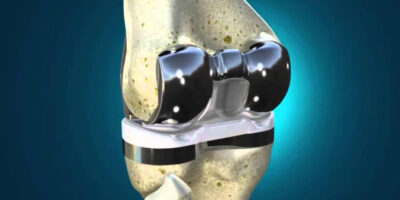 Artificial Cartilage Implant Market