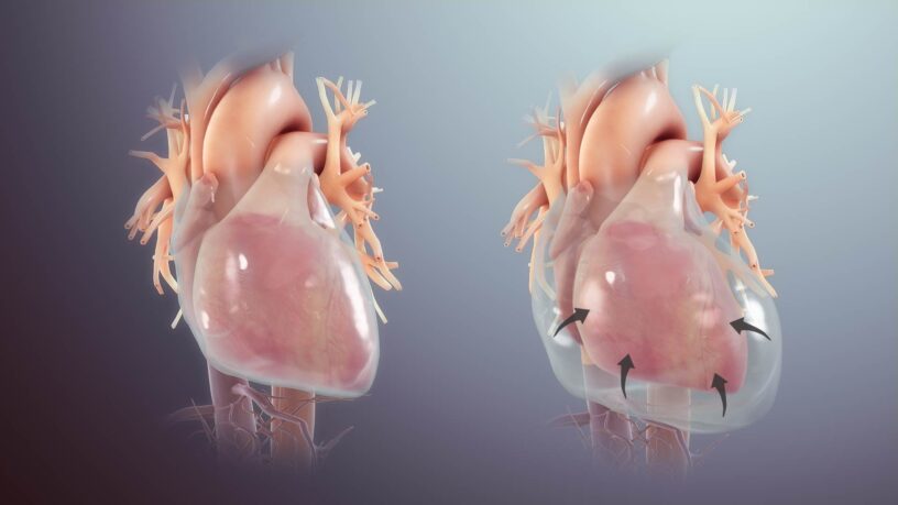 Pericarditis Market