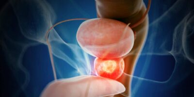 Prostate Cancer Market