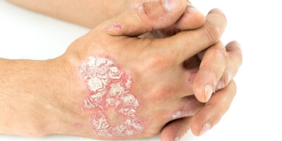 Systemic Psoriasis Therapeutics Market