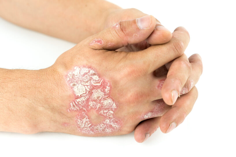 Systemic Psoriasis Therapeutics Market