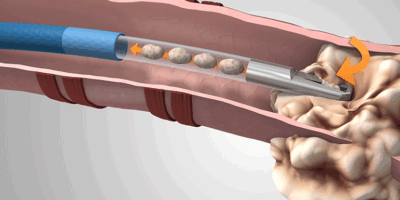 Lung Biopsy Systems Market